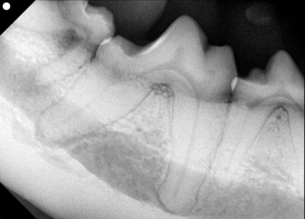 Dental X-ray, molar teeth